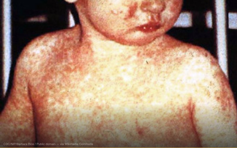 Measles. This child shows a classic day-4 rash with measles. — related to Vaccine-Induced Myocarditis Conspiracy