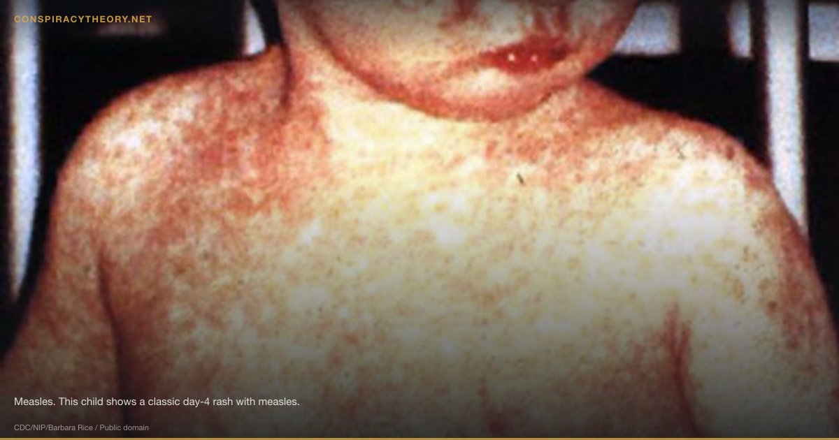 Vaccine–Autism Link (1998) — Measles. This child shows a classic day-4 rash with measles.